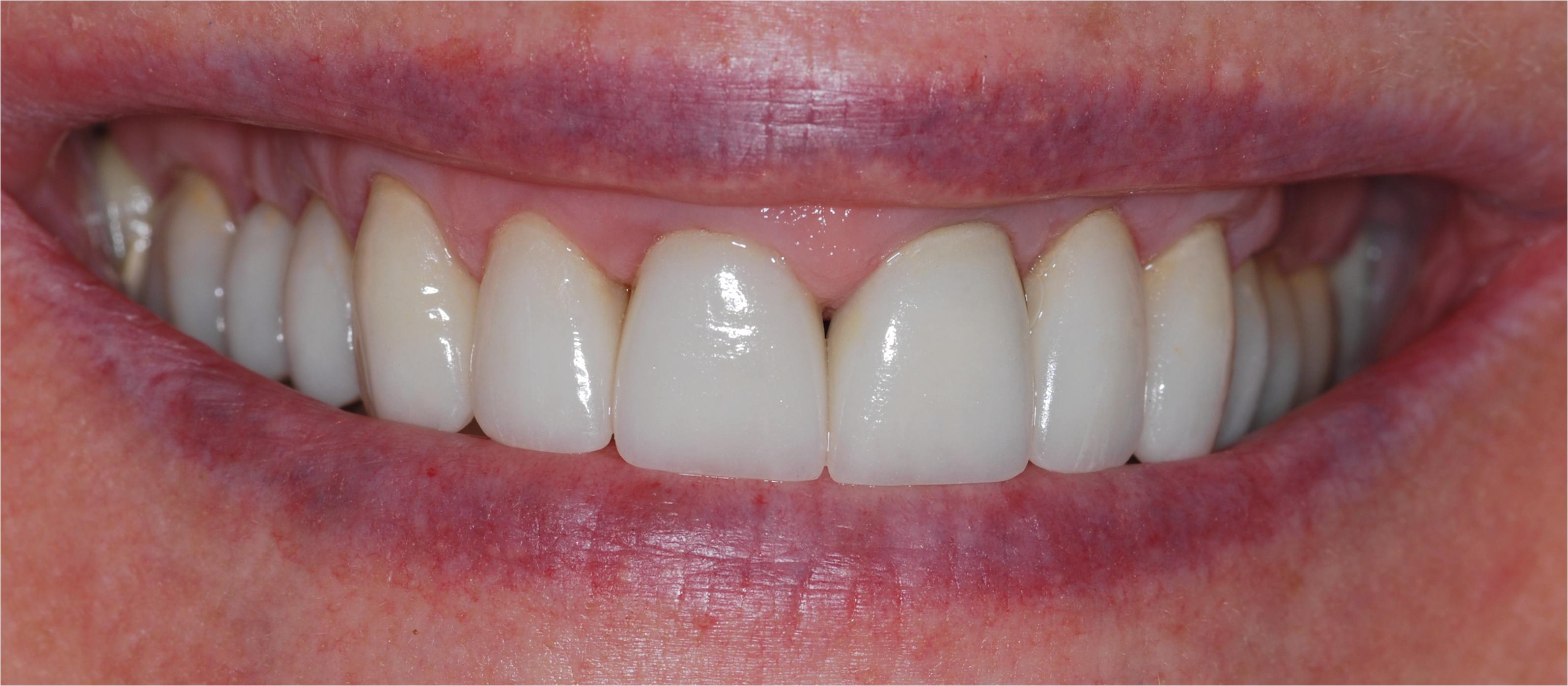 Lynette Herd Dental Case Study3