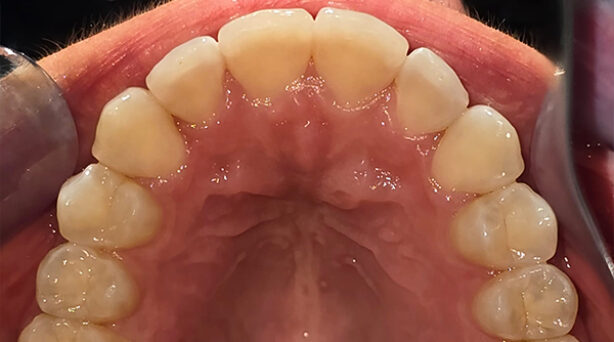After - The Beresford Dental Clinic