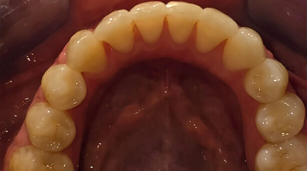 After - The Beresford Dental Clinic