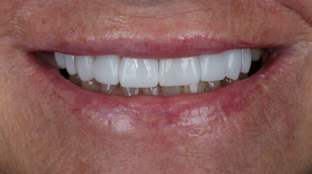 After - The Beresford Dental Clinic