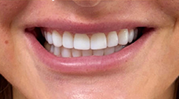 After - The Beresford Dental Clinic
