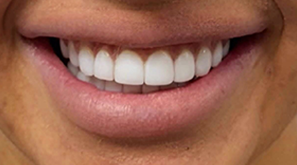After - The Beresford Dental Clinic