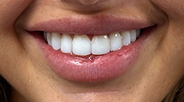 After - The Beresford Dental Clinic