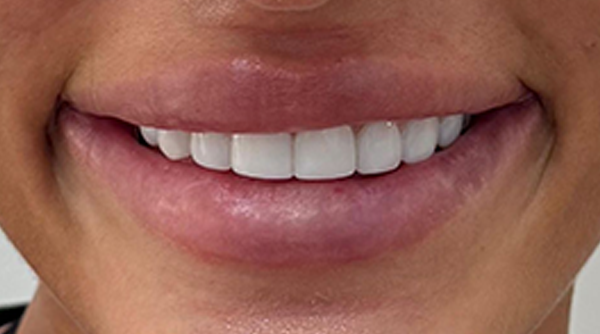 After - The Beresford Dental Clinic