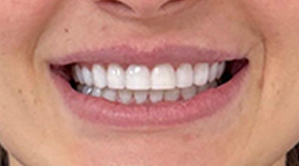 After - The Beresford Dental Clinic