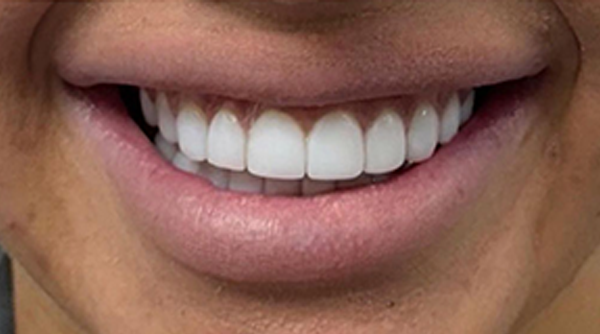 After - The Beresford Dental Clinic