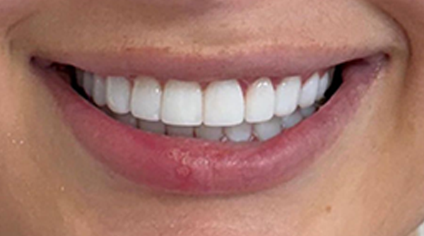 After - The Beresford Dental Clinic