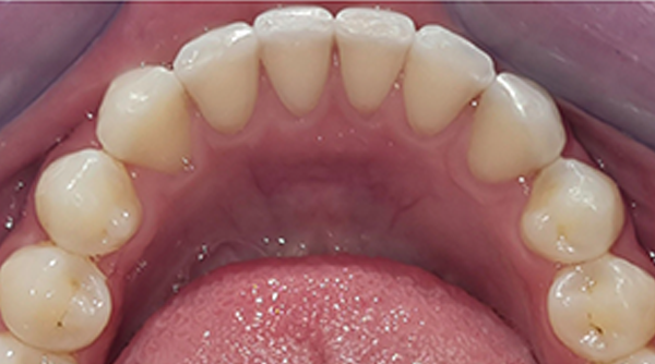 After - The Beresford Dental Clinic