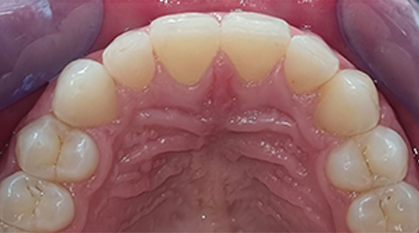 After - The Beresford Dental Clinic