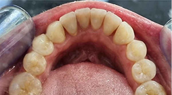 After - The Beresford Dental Clinic
