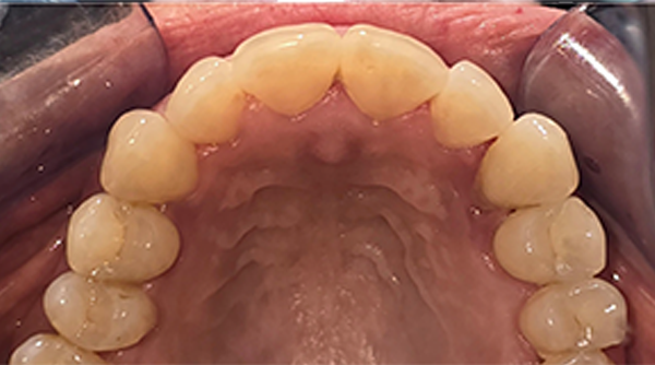 After - The Beresford Dental Clinic