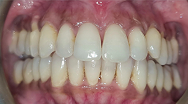 After - The Beresford Dental Clinic