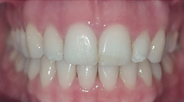 After - The Beresford Dental Clinic