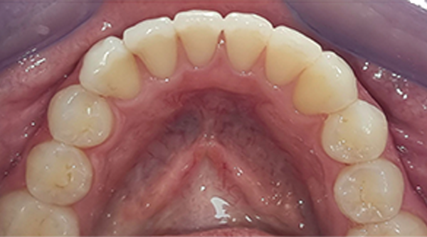 After - The Beresford Dental Clinic
