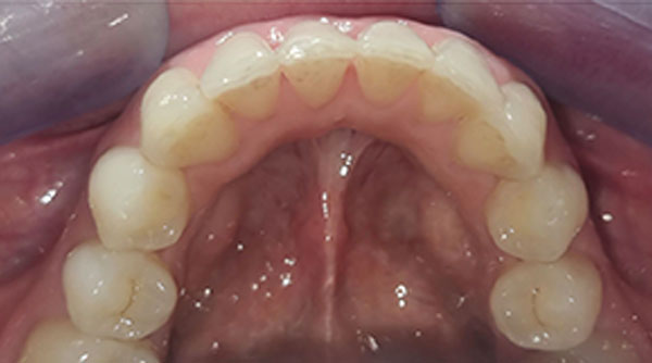After - The Beresford Dental Clinic
