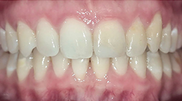 After - The Beresford Dental Clinic