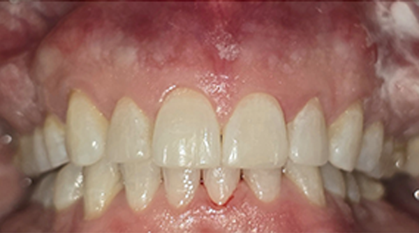 After - The Beresford Dental Clinic