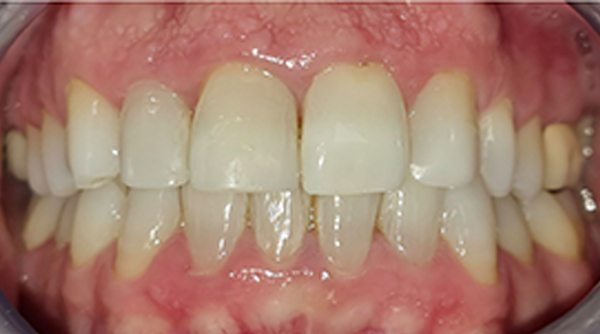 After - The Beresford Dental Clinic