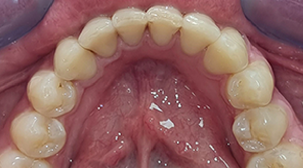 After - The Beresford Dental Clinic