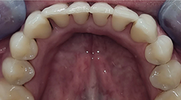 After - The Beresford Dental Clinic