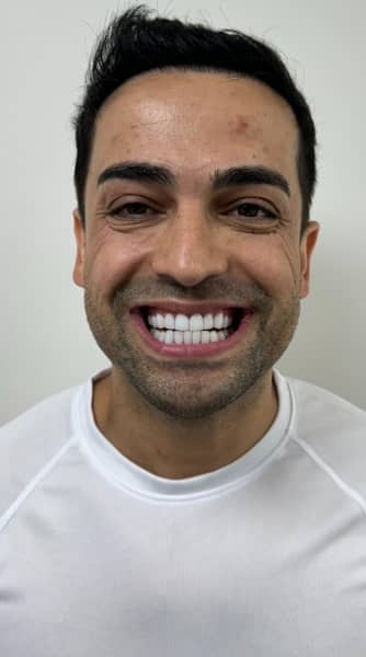 Face After - The Beresford Dental Clinic