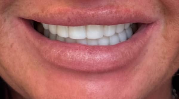 After - The Beresford Dental Clinic