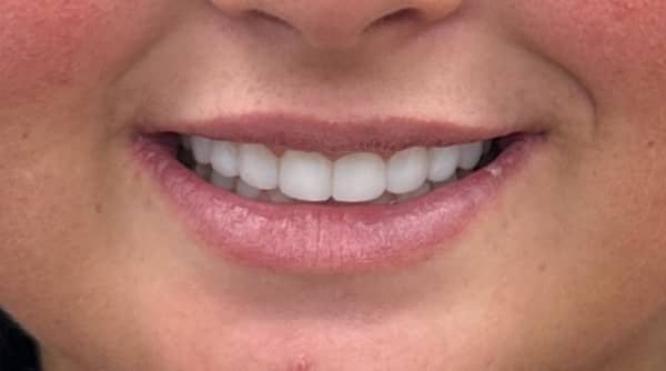 After - The Beresford Dental Clinic