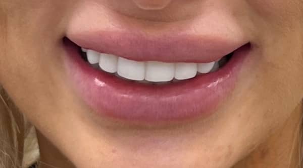 After - The Beresford Dental Clinic