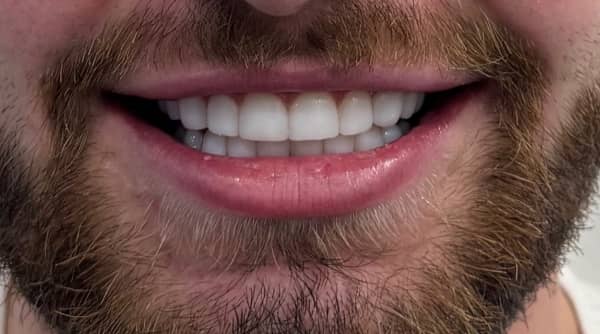 After - The Beresford Dental Clinic