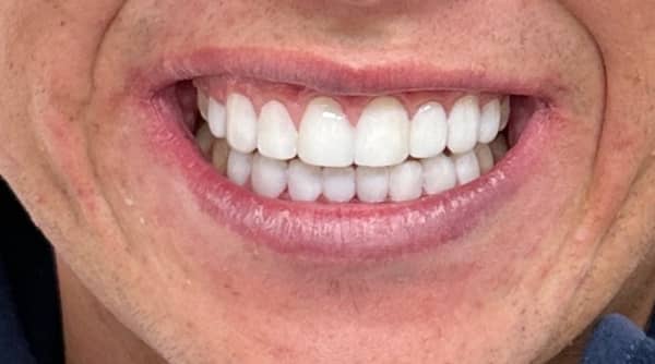 After - The Beresford Dental Clinic