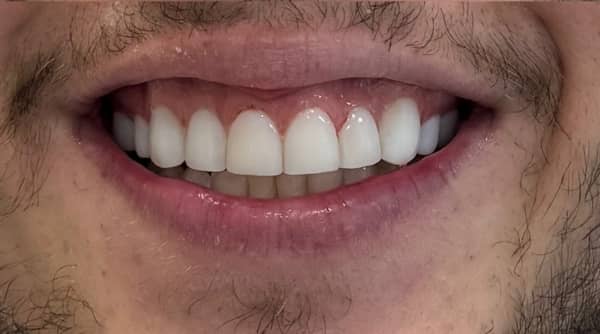 After - The Beresford Dental Clinic