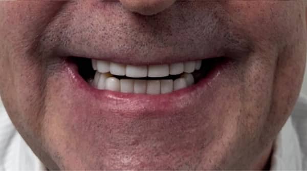 After - The Beresford Dental Clinic