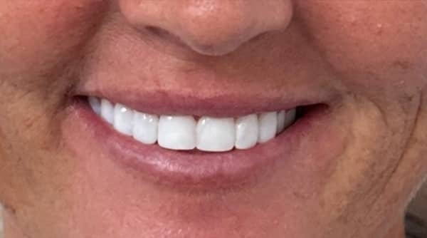 After - The Beresford Dental Clinic