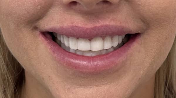 After - The Beresford Dental Clinic