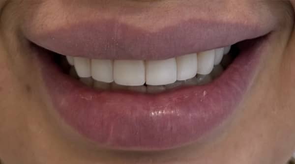 After - The Beresford Dental Clinic