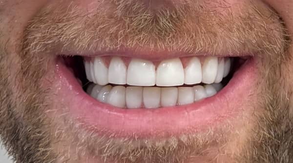 After - The Beresford Dental Clinic