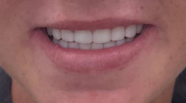 After - The Beresford Dental Clinic