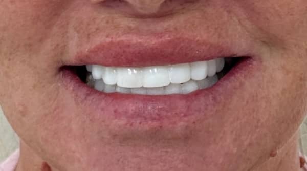 After - The Beresford Dental Clinic