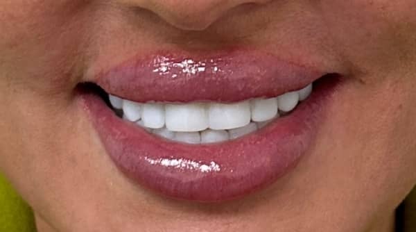 After - The Beresford Dental Clinic