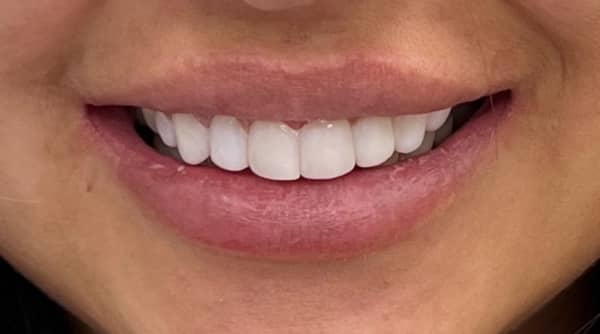 After - The Beresford Dental Clinic