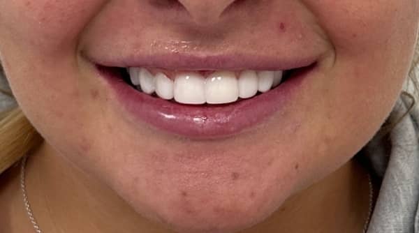 After - The Beresford Dental Clinic