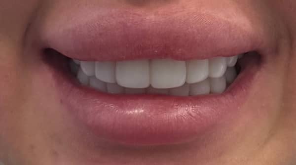 After - The Beresford Dental Clinic