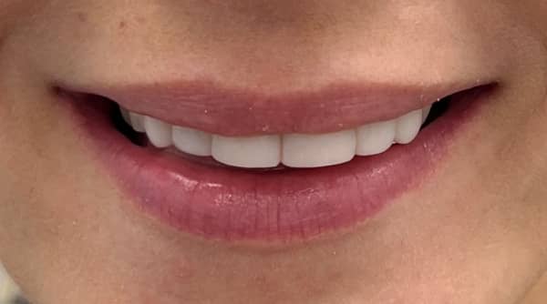 After - The Beresford Dental Clinic