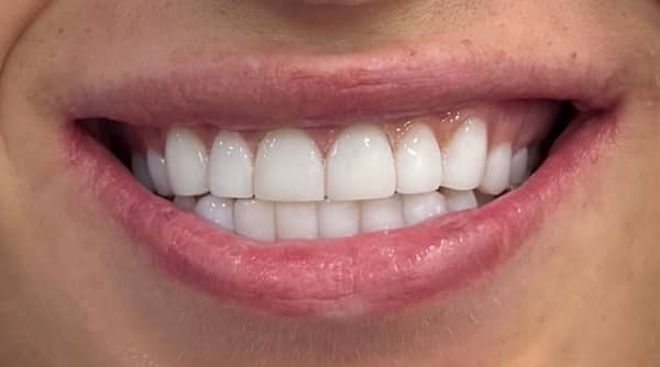 After - The Beresford Dental Clinic