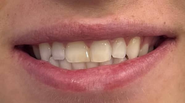Before - The Beresford Dental Clinic
