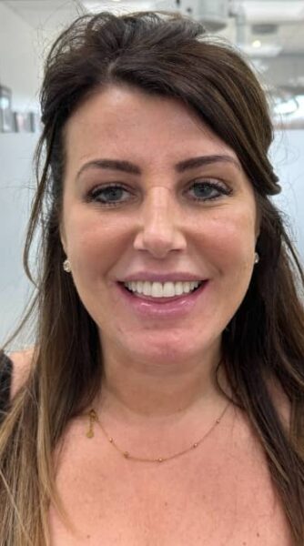 Face After - The Beresford Dental Clinic