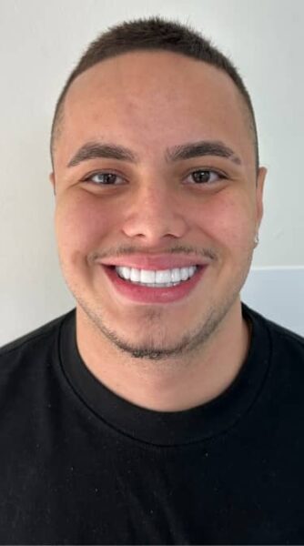Face After - The Beresford Dental Clinic