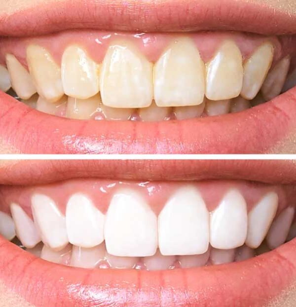 Blog - The Beresford Dental Clinic