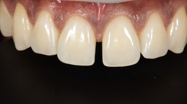 Before - The Beresford Dental Clinic