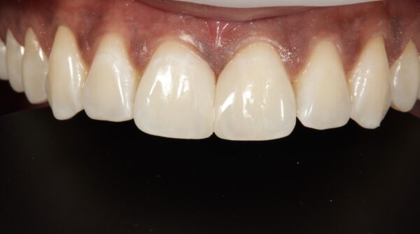 After - The Beresford Dental Clinic